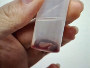 Người đàn ông chảy máu mũi vì con vắt sống ký sinh trong hốc mũi