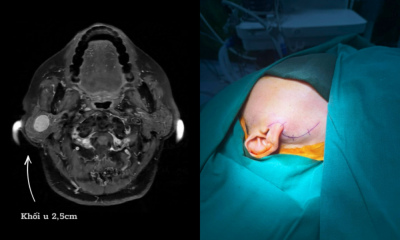 Phẫu Thuật U Tuyến Mang Tai - Loại Bỏ Nguy Cơ Liệt Mặt Nhờ Ứng Dụng Máy Dò Thần Kinh.