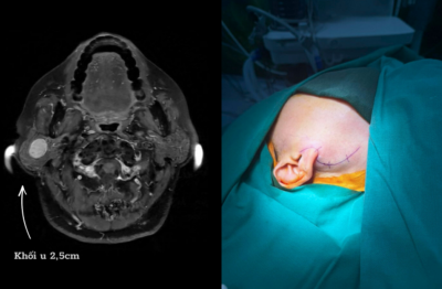 Phẫu Thuật U Tuyến Mang Tai - Loại Bỏ Nguy Cơ Liệt Mặt Nhờ Ứng Dụng Máy Dò Thần Kinh.