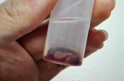 Người đàn ông chảy máu mũi vì con vắt sống ký sinh trong hốc mũi