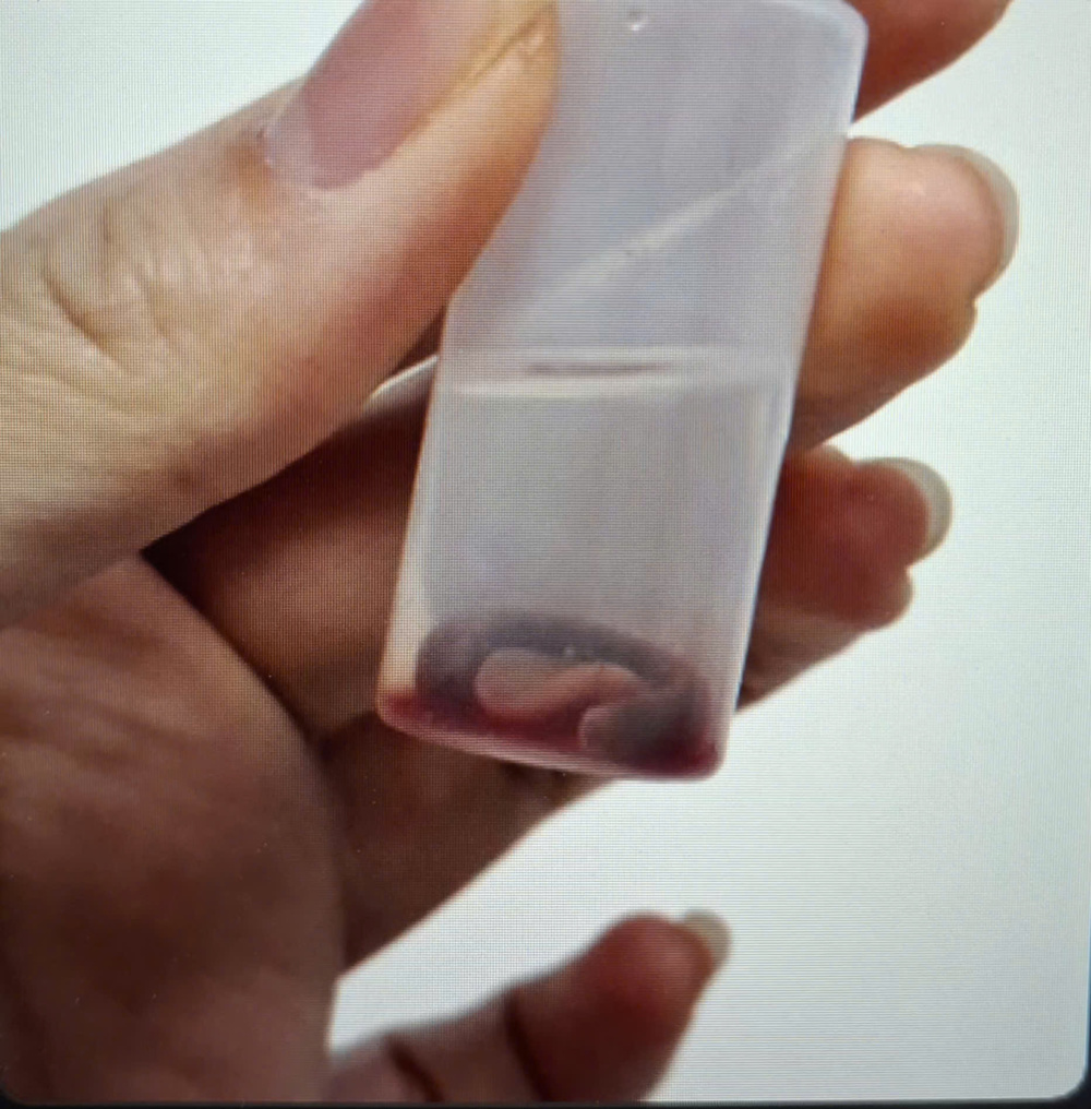 Người đàn ông chảy máu mũi vì con vắt sống ký sinh trong hốc mũi